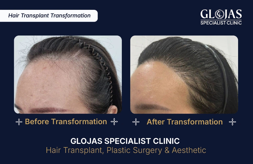 hairline-lowering-malaysia-forehead-reduction-surgery-kuala-lumpur-hair-transplant-malaysia