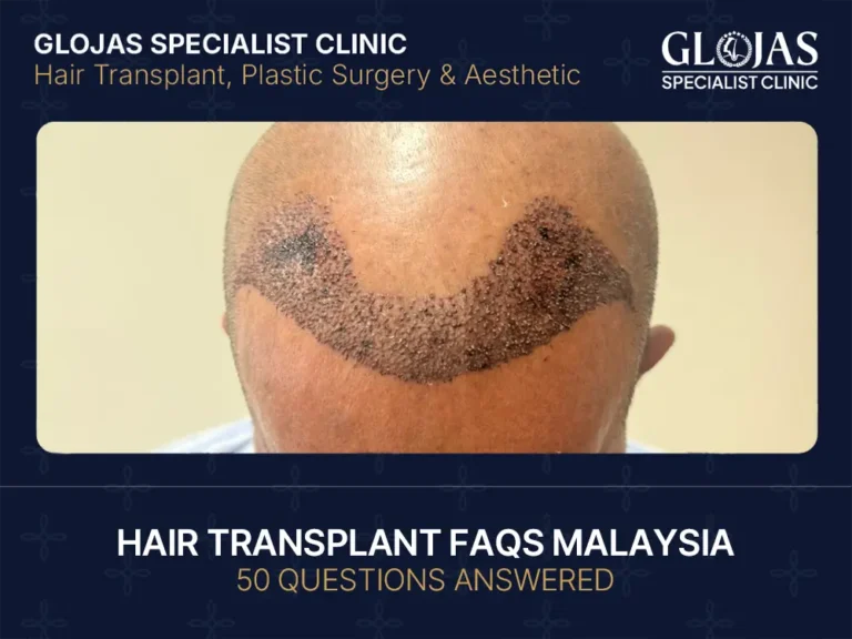 hair-transplant-faqs-malaysia