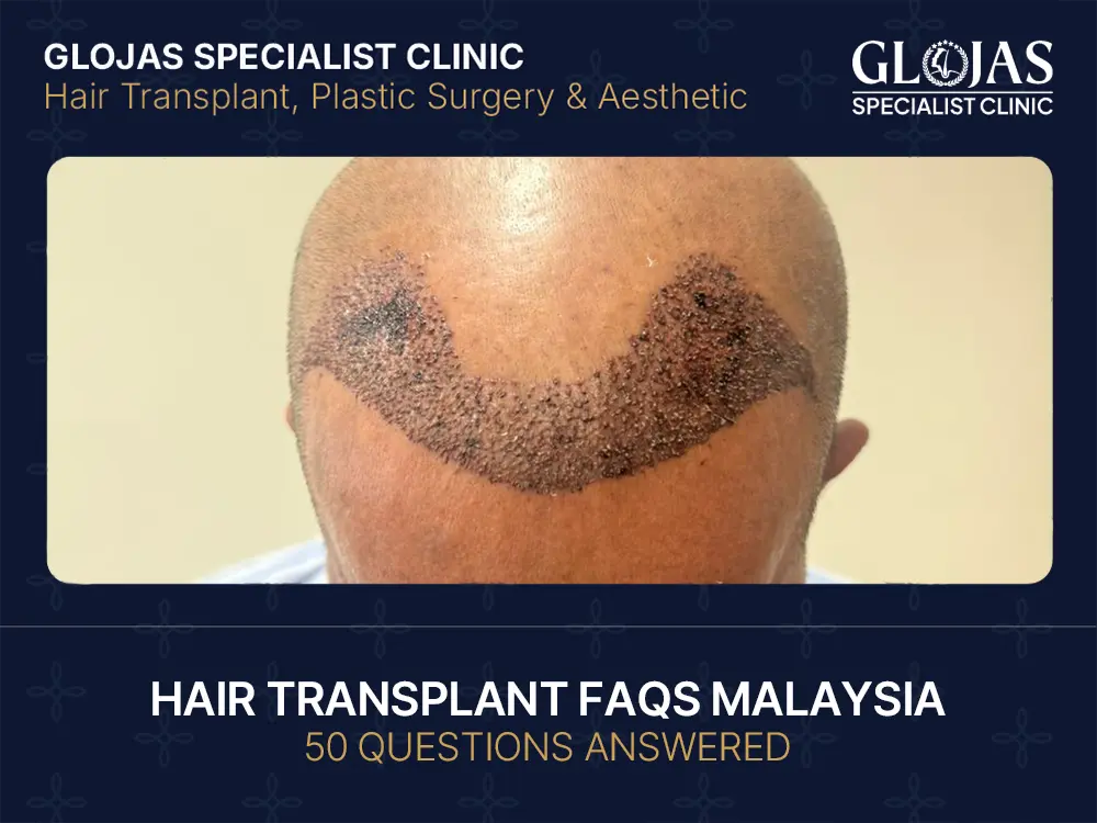 Hair Transplant FAQs Malaysia: 50 Questions Answered 11 hair-transplant-faqs-malaysia