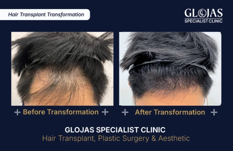 hair-transplant-results-kuala-lumpur-malaysia