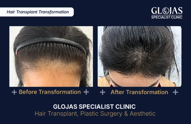 hair-transplant-results-kuala-lumpur-malaysia