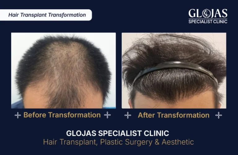 hair-transplant-results-kuala-lumpur-malaysia