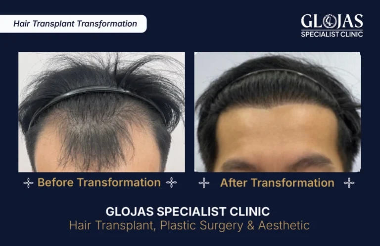 hair-transplant-results-kuala-lumpur-malaysia