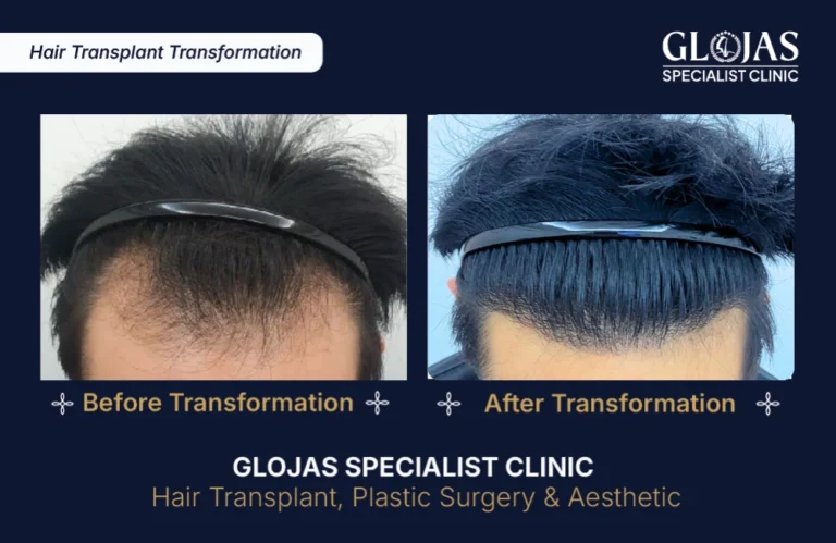 hair-transplant-results-kuala-lumpur-malaysia