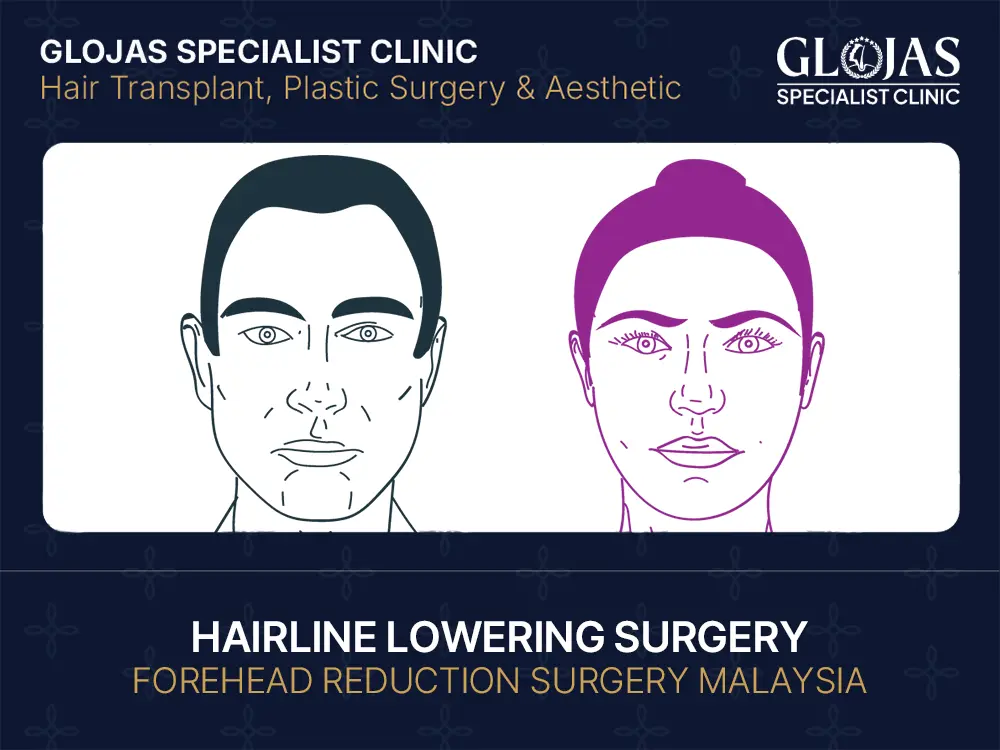 Hairline Lowering Surgery: Forehead Reduction & Natural Hairline Advancement 7 hairline-lowering-surgery-forehead-reduction-malaysia