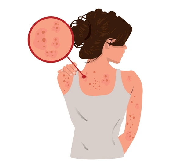 back-acne-treatment-malaysia