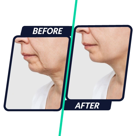 hifu-face-tightening