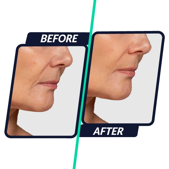 hifu-treatment-malaysia