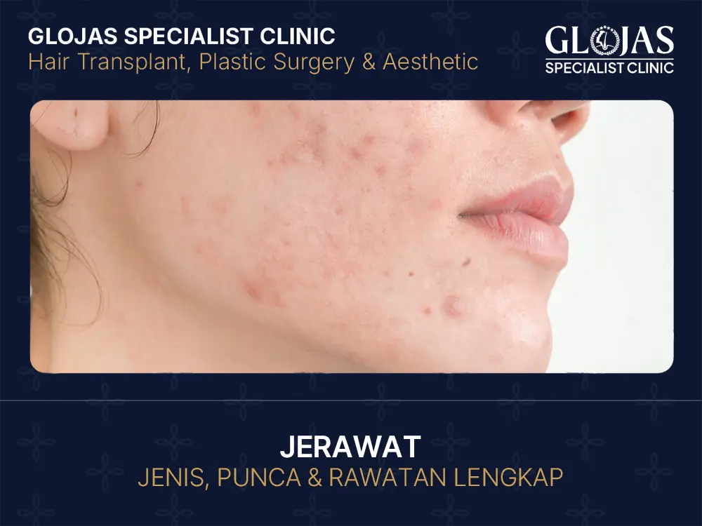 Jerawat: Punca, Jenis & Cara Hilangkan Jerawat Dengan Rawatan Berkesan