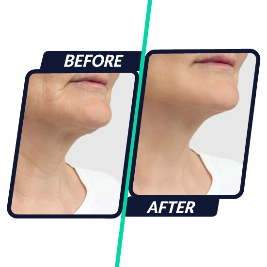 neck-lift-facial-tightening