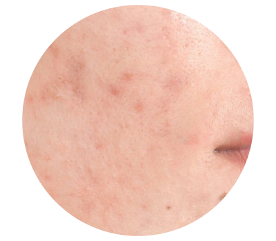 pico-laser-malaysia-for-acne-scar