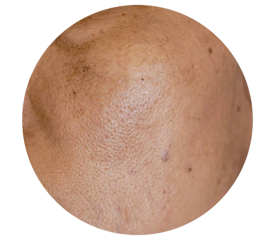 pico-laser-malaysia-for-pigmentation