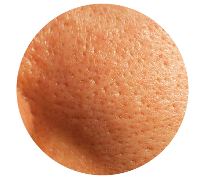 pico-laser-malaysia-for-pore-reduction