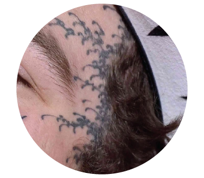 pico-laser-malaysia-for-tattoo-removal