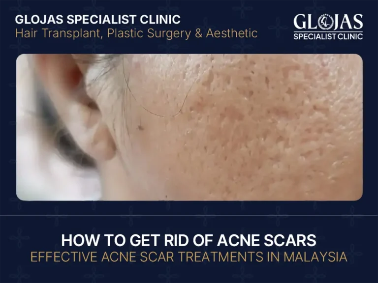 How to Get Rid of Acne Scars