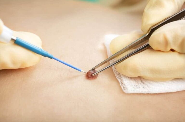 wart-removal-treatment-kuala-lumpur-malaysia-near-me