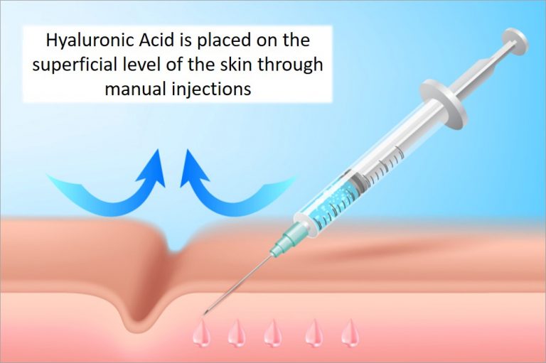 skin-booster-injection