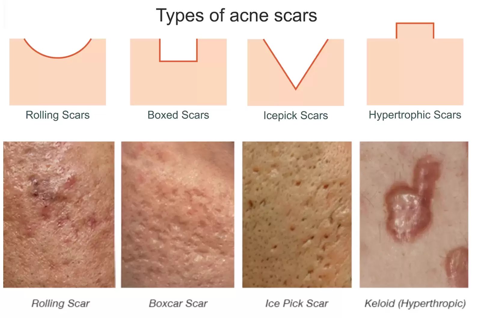 acne-scar-treatment-acne-scar-type
