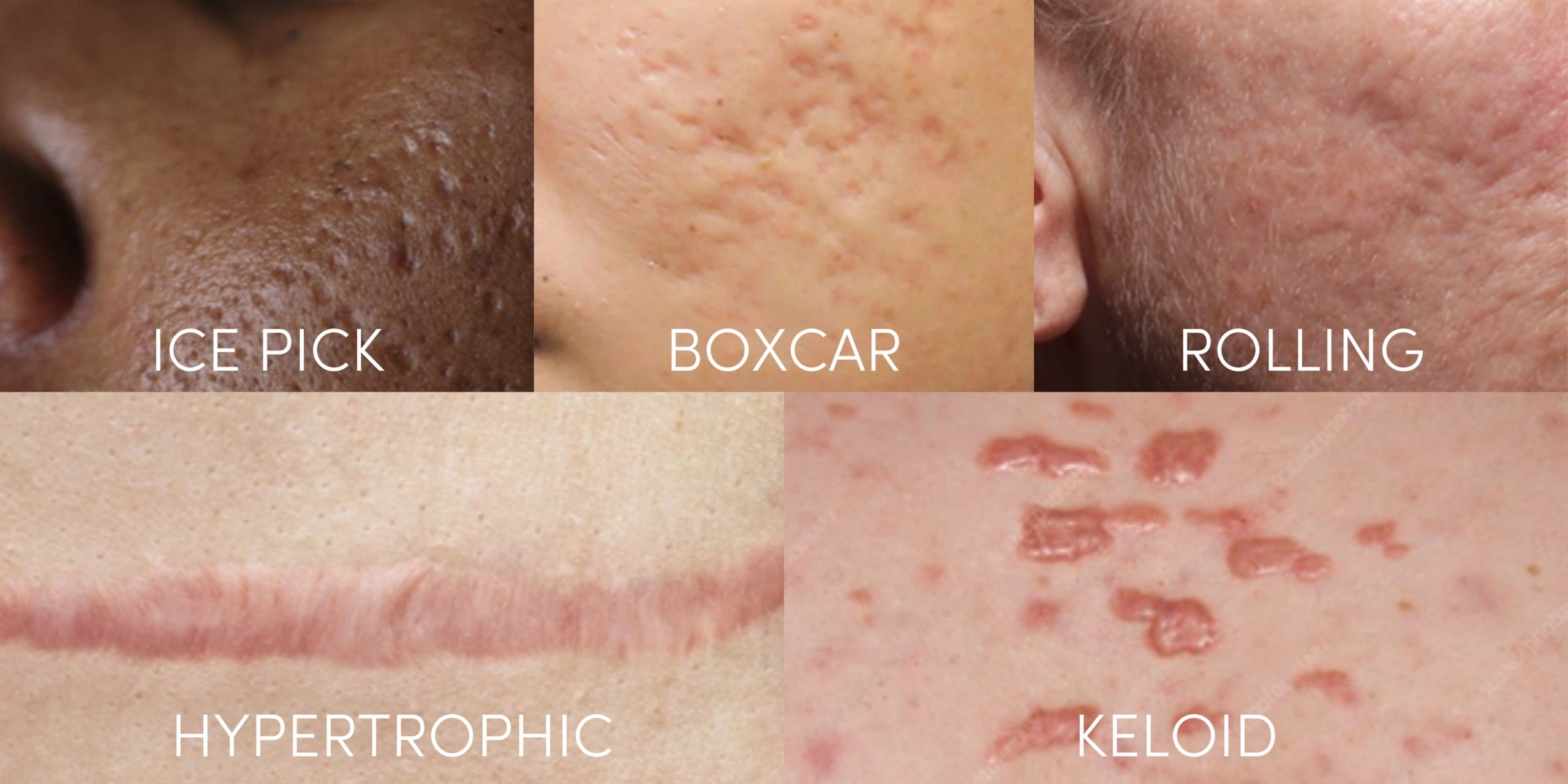 acne scars types treatments malaysia