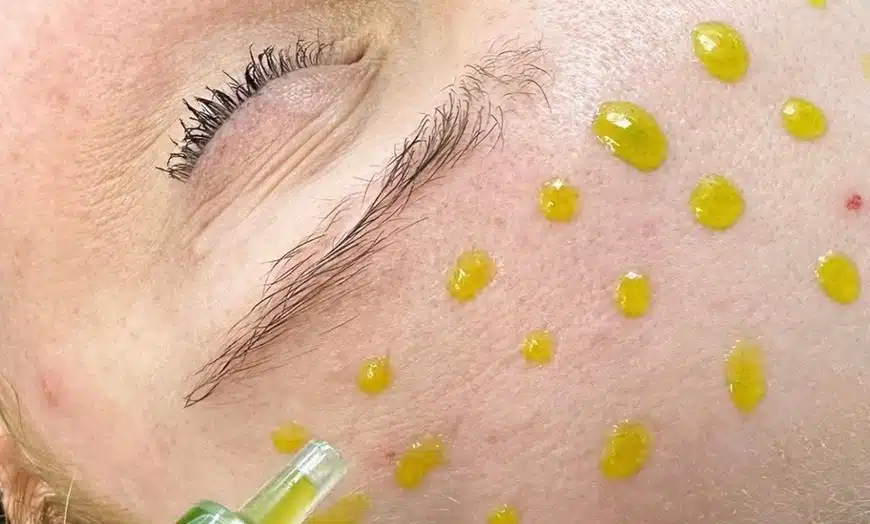 9 Cara Hilangkan Whitehead Untuk Kulit Bersih dan Sihat (2025) 3 cara-hilangkan-whitehead-biorepeel-malaysia