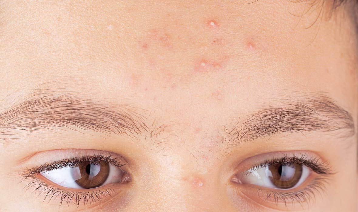 9 Cara Hilangkan Whitehead Untuk Kulit Bersih dan Sihat (2025) 1 cara-hilangkan-whitehead