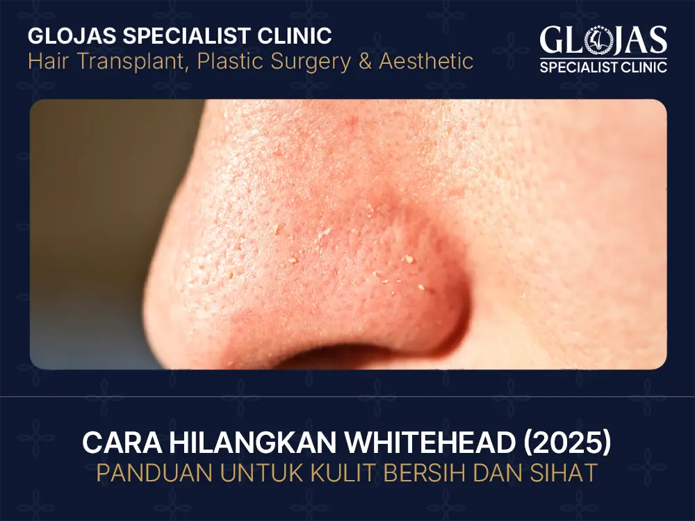 9 Cara Hilangkan Whitehead Untuk Kulit Bersih dan Sihat (2025)