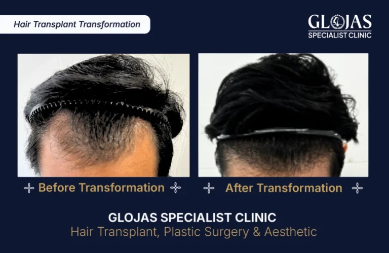 hair-transplant-results-kuala-lumpur-malaysia