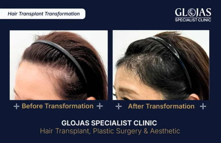 hair-transplant-results-kuala-lumpur-malaysia