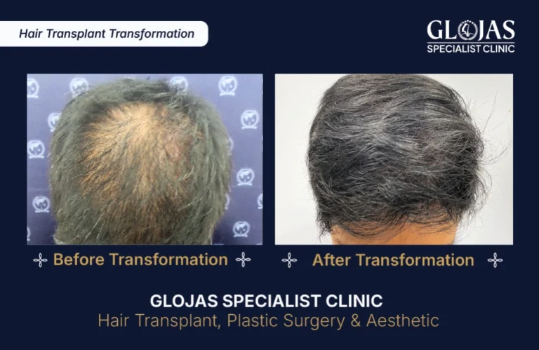 hair-transplant-results-kuala-lumpur-malaysia