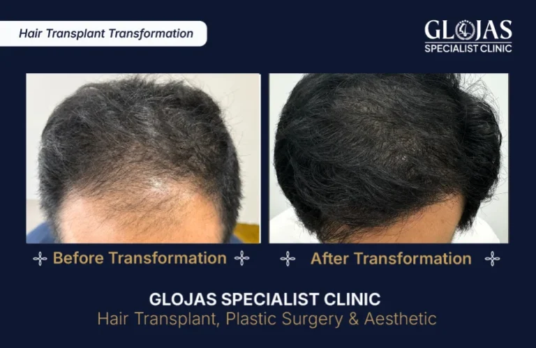 hair-transplant-results-kuala-lumpur-malaysia