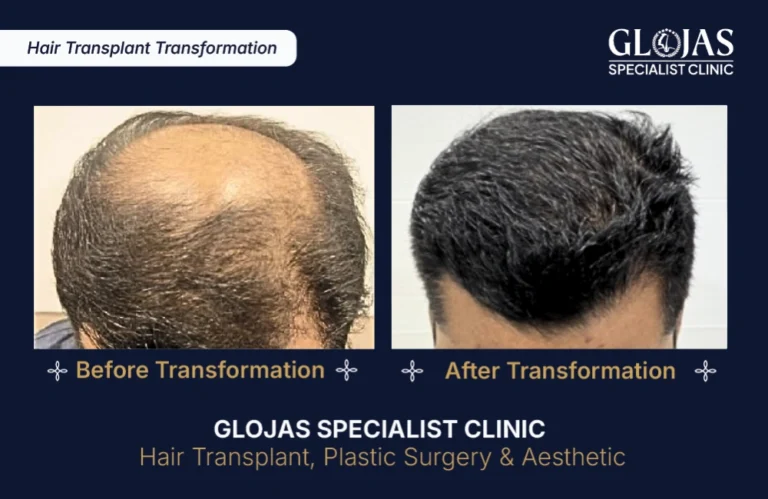hair-transplant-results-kuala-lumpur-malaysia