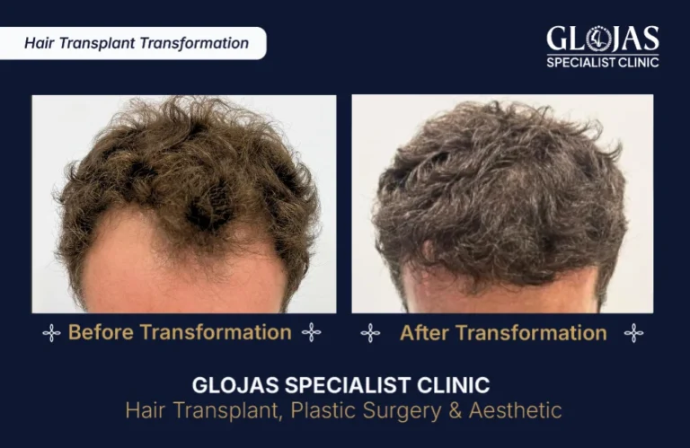 hair-transplant-results-kuala-lumpur-malaysia
