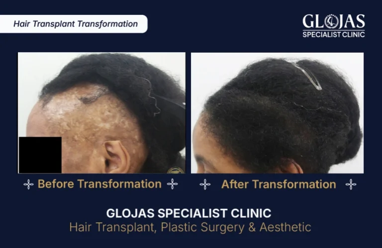 hair-transplant-results-kuala-lumpur-malaysia