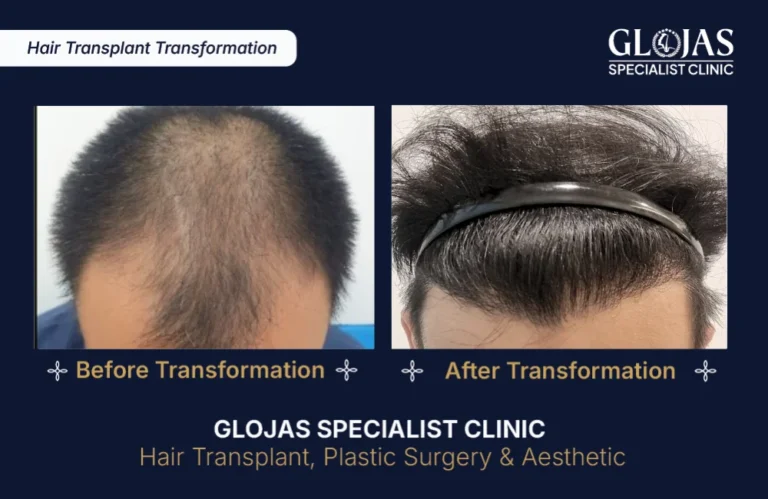 SMART™ FUE Hair Transplant-results-kuala-lumpur-malaysia