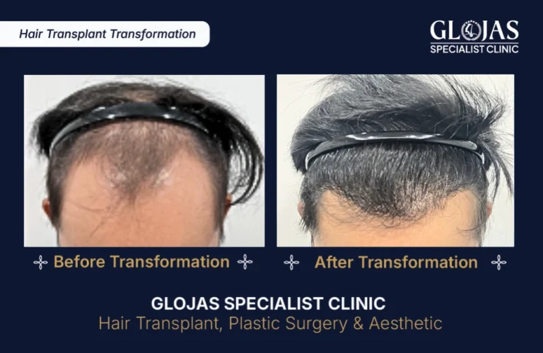 transplantasi-rambut-tanam-rambut-hair-transplant-indonesia