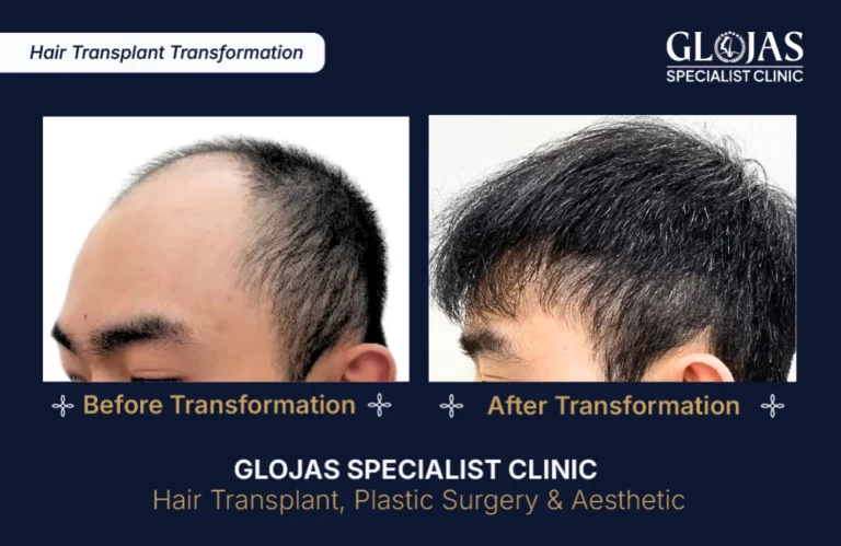 hair-transplant-results-kuala-lumpur-malaysia