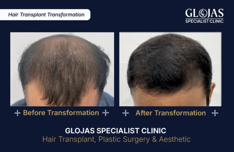 hair-transplant-results-kuala-lumpur-malaysia