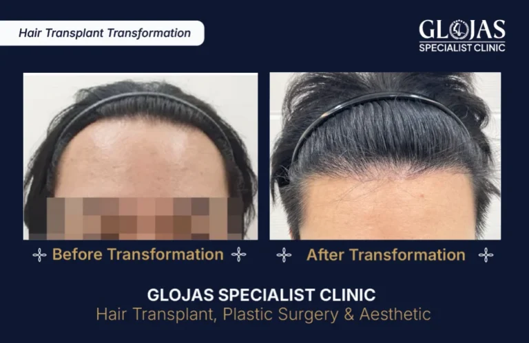 hair-transplant-singapore
