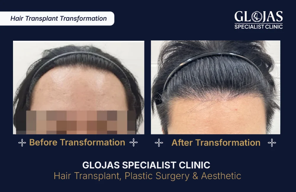 hair-transplant-results-kuala-lumpur-malaysia