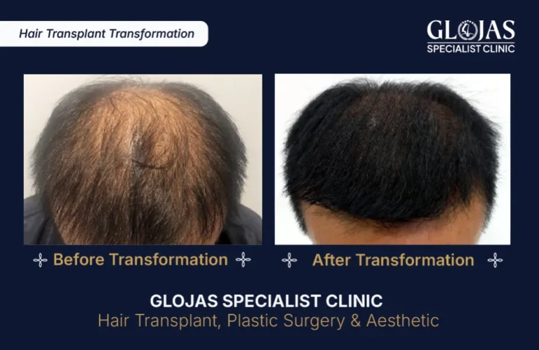 hair-transplant-results-kuala-lumpur-malaysia