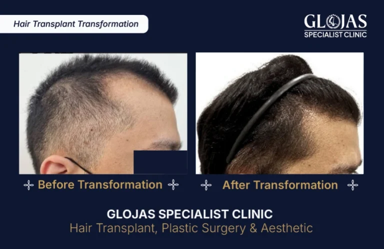 hair-transplant-results-kuala-lumpur-malaysia