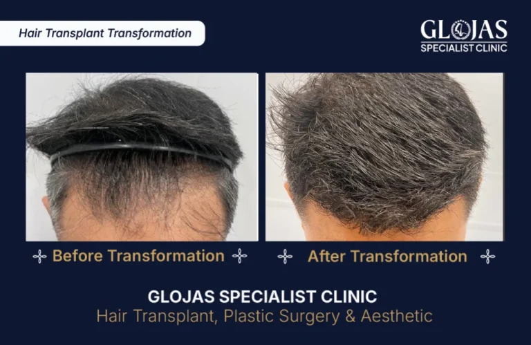 hair-transplant-results-kuala-lumpur-malaysia