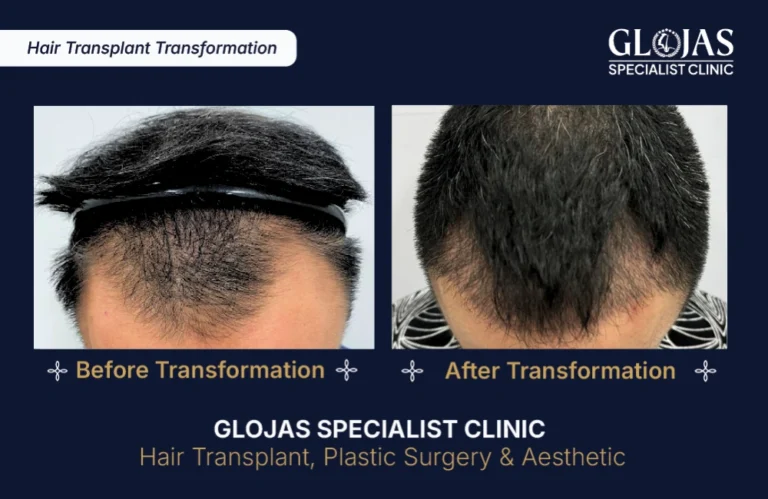 hair-transplant-results-kuala-lumpur-malaysia