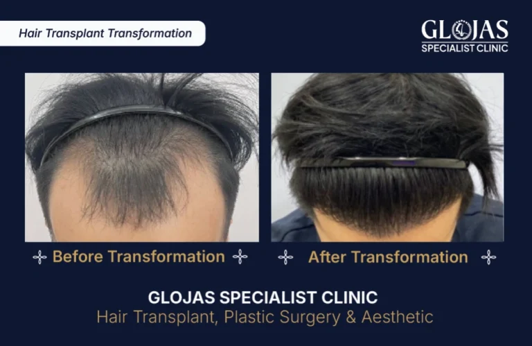 hair-transplant-results-kuala-lumpur-malaysia