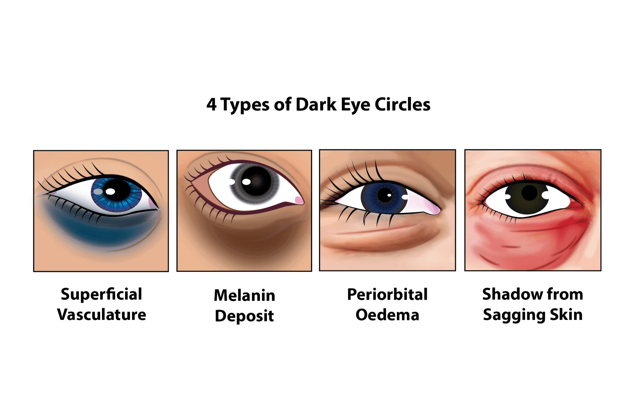 How to Remove Eye Bags Permanently: Causes, Treatments, and Prevention 2 how-to-remove-eye-bags-types