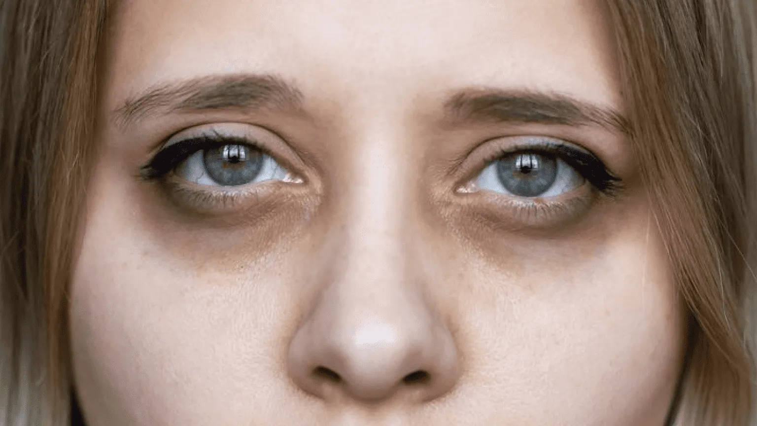 How to Remove Eye Bags Permanently: Causes, Treatments, and Prevention 1 how-to-remove-eye-bags