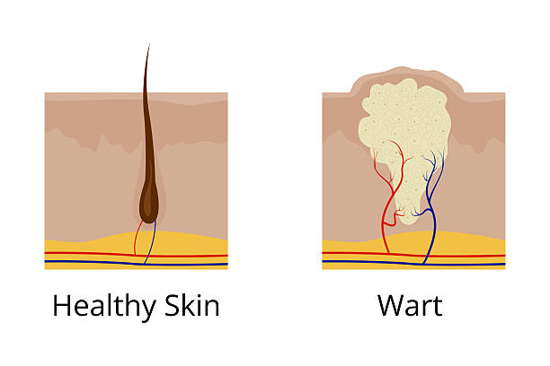 wart-removal-treatment-kuala-lumpur-malaysia-near-me