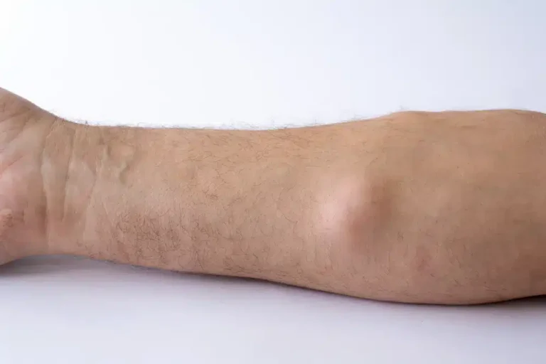 lipoma-removal-treatment-kuala-lumpur-malaysia