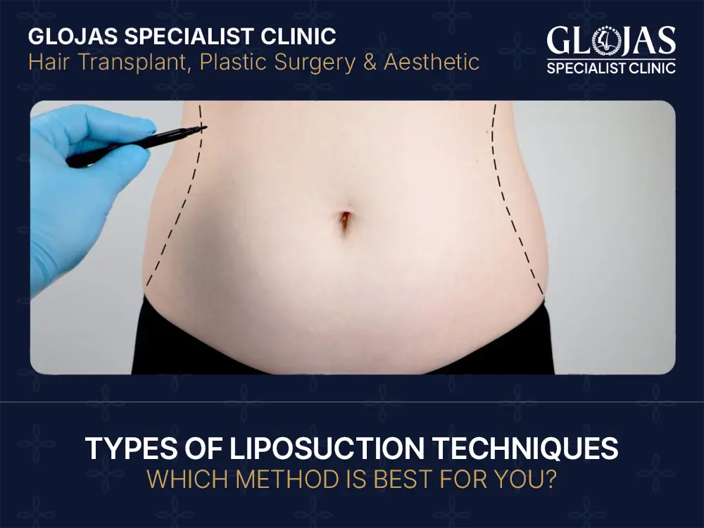 Types of Liposuction Techniques: Which Method is Best for You?
