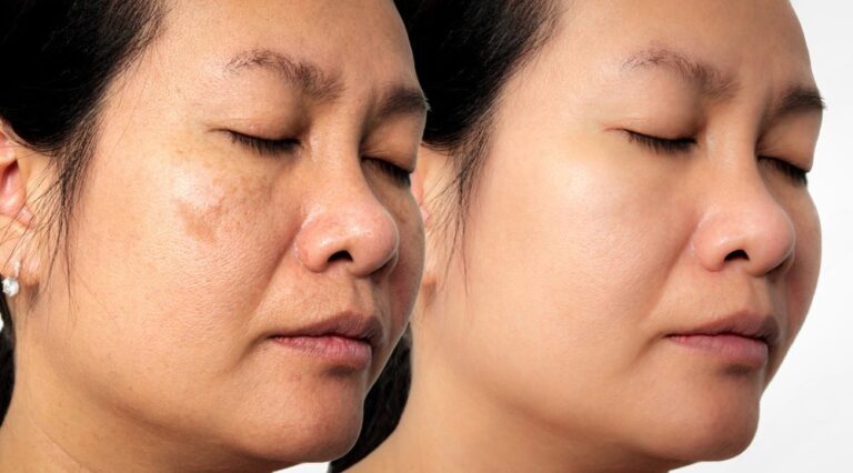 pico-laser-before-after-glojas